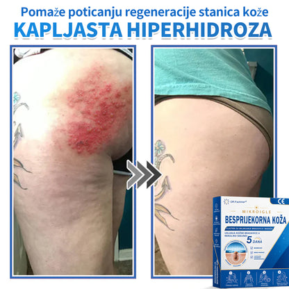 ✅ DR.Fachmer®❤️ 2-u-1 flaster s mikroiglicama i hidrokoloidom | Uklanjanje podignutih madeža, akni, ravnih bradavica i kožnih izraslina | Ublažava bore, ožiljke i mrlje | Nevidljivi flasteri za prištiće za lice i tijelo