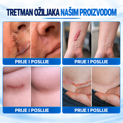 Dr.Fachmer®🏆Bio-regenerativni mikroiglični flaster za ožiljke – silikonska njega s reparativnim proteinima