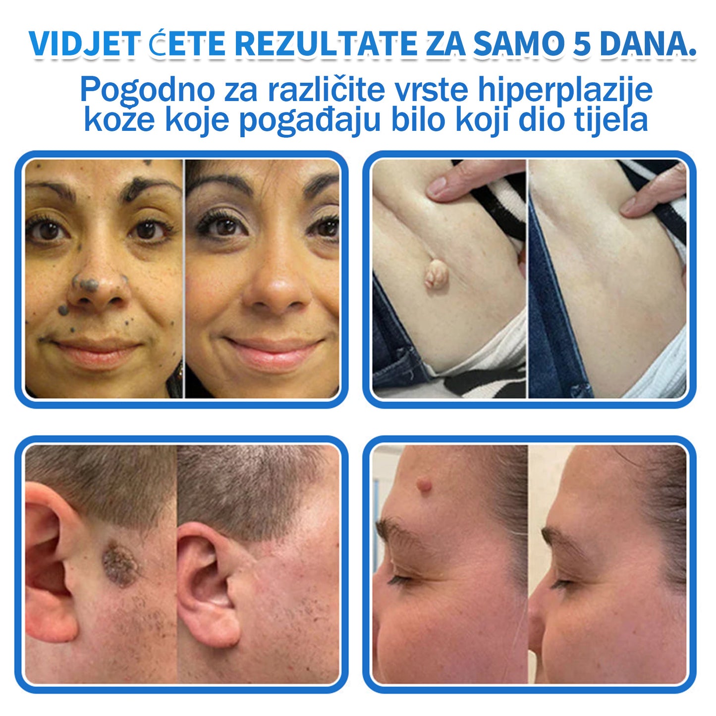 ✅ DR.Fachmer®❤️ 2-u-1 flaster s mikroiglicama i hidrokoloidom | Uklanjanje podignutih madeža, akni, ravnih bradavica i kožnih izraslina | Ublažava bore, ožiljke i mrlje | Nevidljivi flasteri za prištiće za lice i tijelo