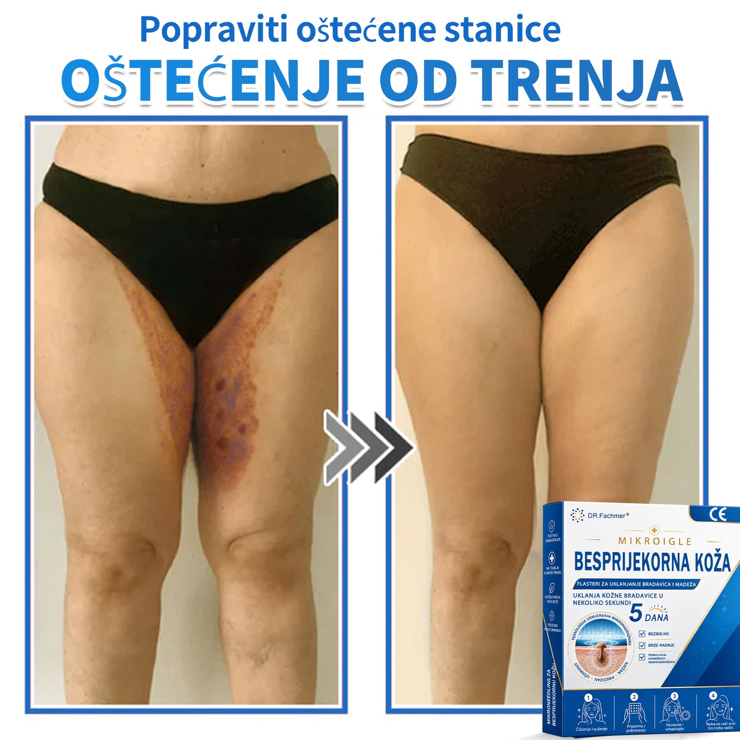 ✅ DR.Fachmer®❤️ 2-u-1 flaster s mikroiglicama i hidrokoloidom | Uklanjanje podignutih madeža, akni, ravnih bradavica i kožnih izraslina | Ublažava bore, ožiljke i mrlje | Nevidljivi flasteri za prištiće za lice i tijelo