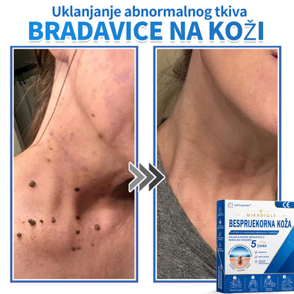 ✅ DR.Fachmer®❤️ 2-u-1 flaster s mikroiglicama i hidrokoloidom | Uklanjanje podignutih madeža, akni, ravnih bradavica i kožnih izraslina | Ublažava bore, ožiljke i mrlje | Nevidljivi flasteri za prištiće za lice i tijelo