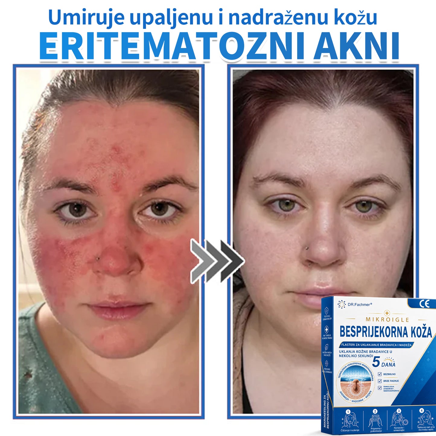 ✅ DR.Fachmer®❤️ 2-u-1 flaster s mikroiglicama i hidrokoloidom | Uklanjanje podignutih madeža, akni, ravnih bradavica i kožnih izraslina | Ublažava bore, ožiljke i mrlje | Nevidljivi flasteri za prištiće za lice i tijelo