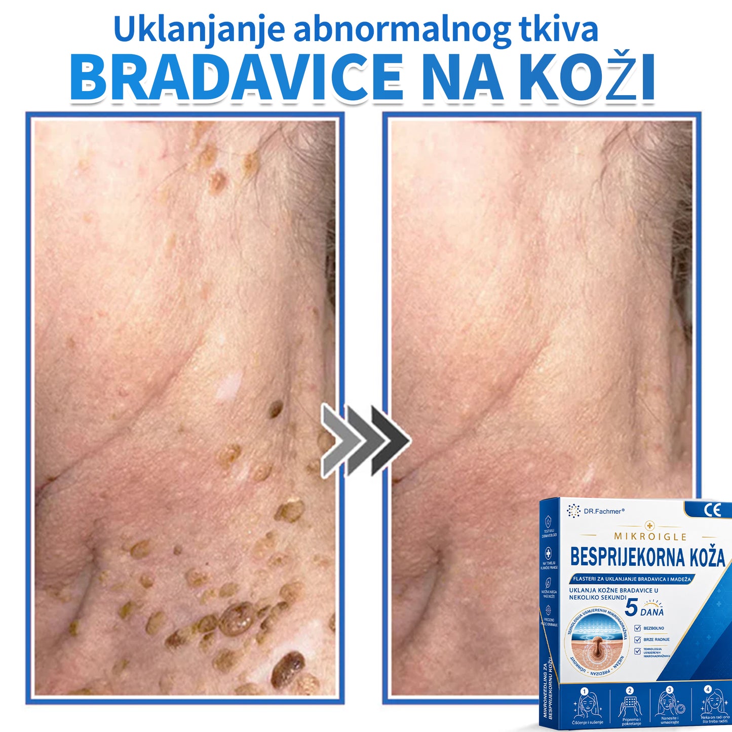 ✅ DR.Fachmer®❤️ 2-u-1 flaster s mikroiglicama i hidrokoloidom | Uklanjanje podignutih madeža, akni, ravnih bradavica i kožnih izraslina | Ublažava bore, ožiljke i mrlje | Nevidljivi flasteri za prištiće za lice i tijelo