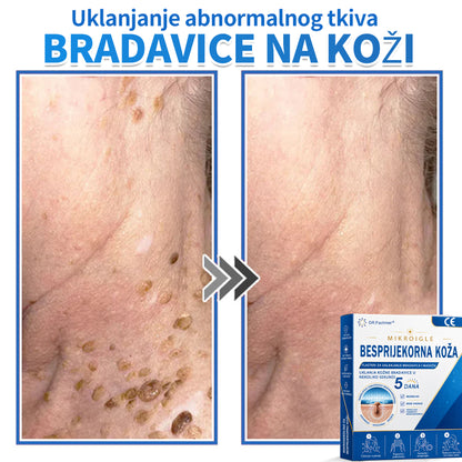 ✅ DR.Fachmer®❤️ 2-u-1 flaster s mikroiglicama i hidrokoloidom | Uklanjanje podignutih madeža, akni, ravnih bradavica i kožnih izraslina | Ublažava bore, ožiljke i mrlje | Nevidljivi flasteri za prištiće za lice i tijelo