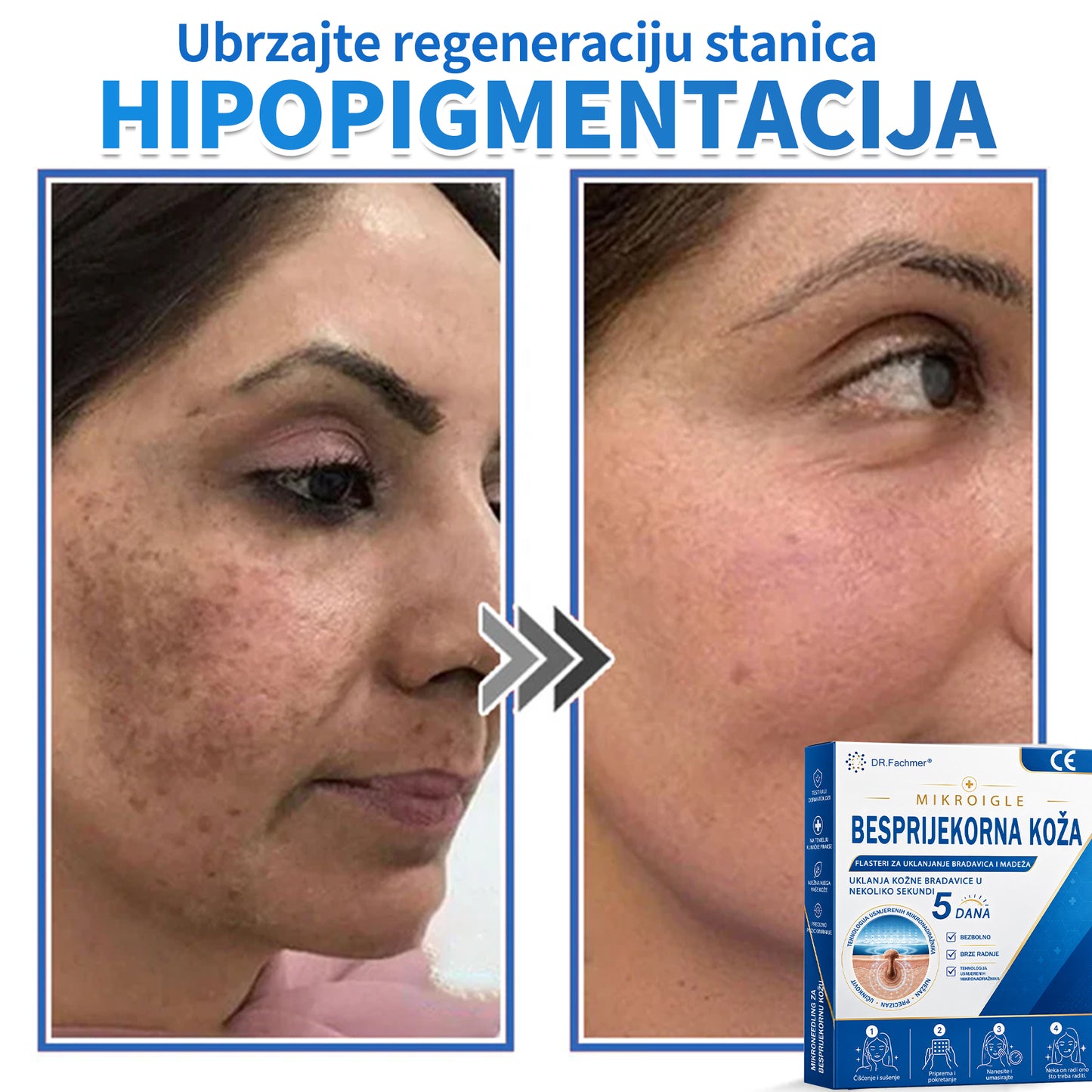 ✅ DR.Fachmer®❤️ 2-u-1 flaster s mikroiglicama i hidrokoloidom | Uklanjanje podignutih madeža, akni, ravnih bradavica i kožnih izraslina | Ublažava bore, ožiljke i mrlje | Nevidljivi flasteri za prištiće za lice i tijelo